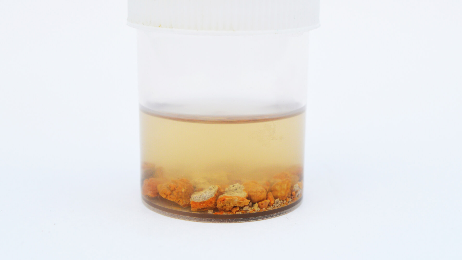 Kidney Stones Jar Image